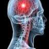 meningitis